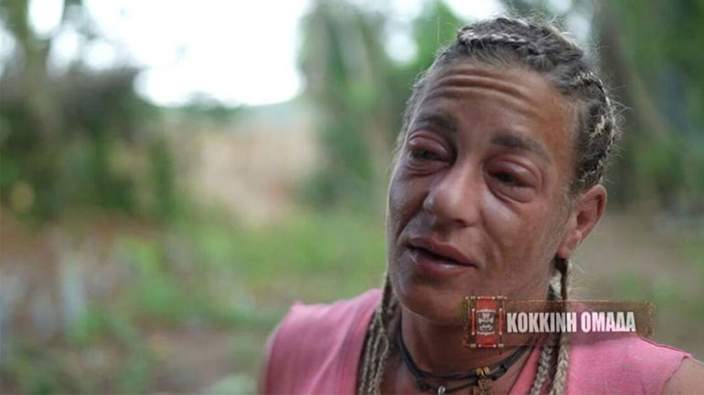 Survivor All Star – Αφροδίτη Σκαφίδα: Το αλλεργικό σοκ που παραμόρφωσε το πρόσωπό της