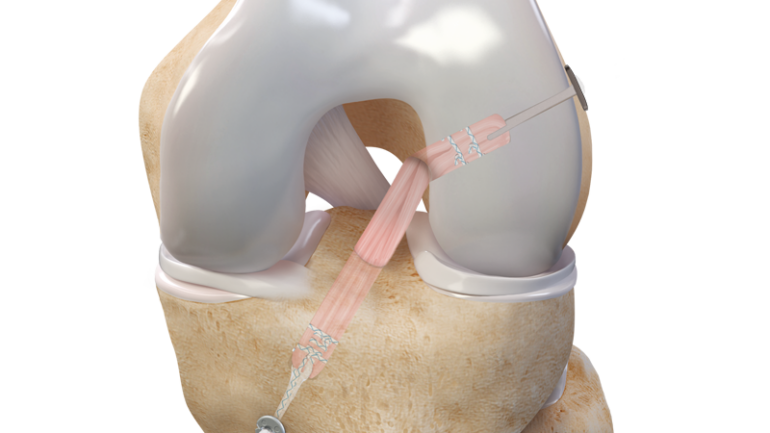 Ρήξη Πρόσθιου Χιαστού: Αντιμετώπιση με την τεχνική All Inside