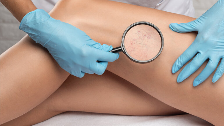 Πότε το ενδοαυλικό Laser πρέπει να προηγείται της σκληροθεραπείας των ευρυαγγειών;