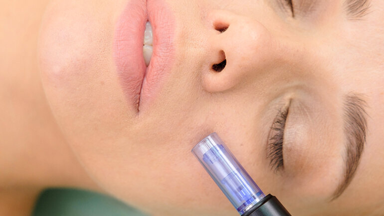 Μεσοθεραπεία: Άμεση ενυδάτωση και λάμψη της επιδερμίδας