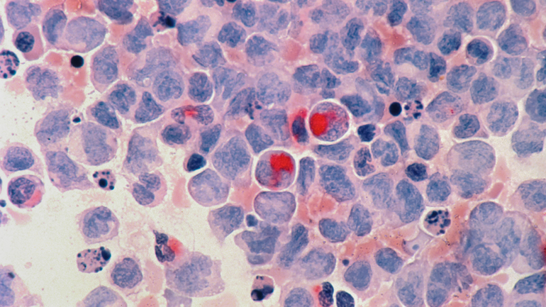 Επιστήμονες ανέπτυξαν ένα νέο τεστ ούρων για την ανίχνευση του καρκίνου