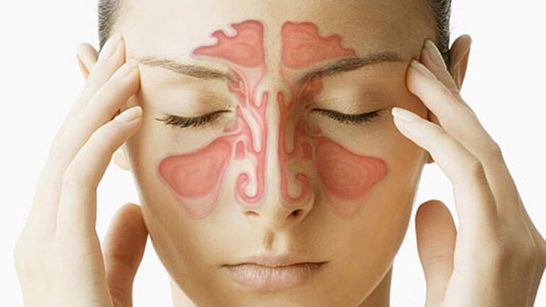 Παραρρινοκολπίτιδα με ή χωρίς ρινικούς πολύποδες