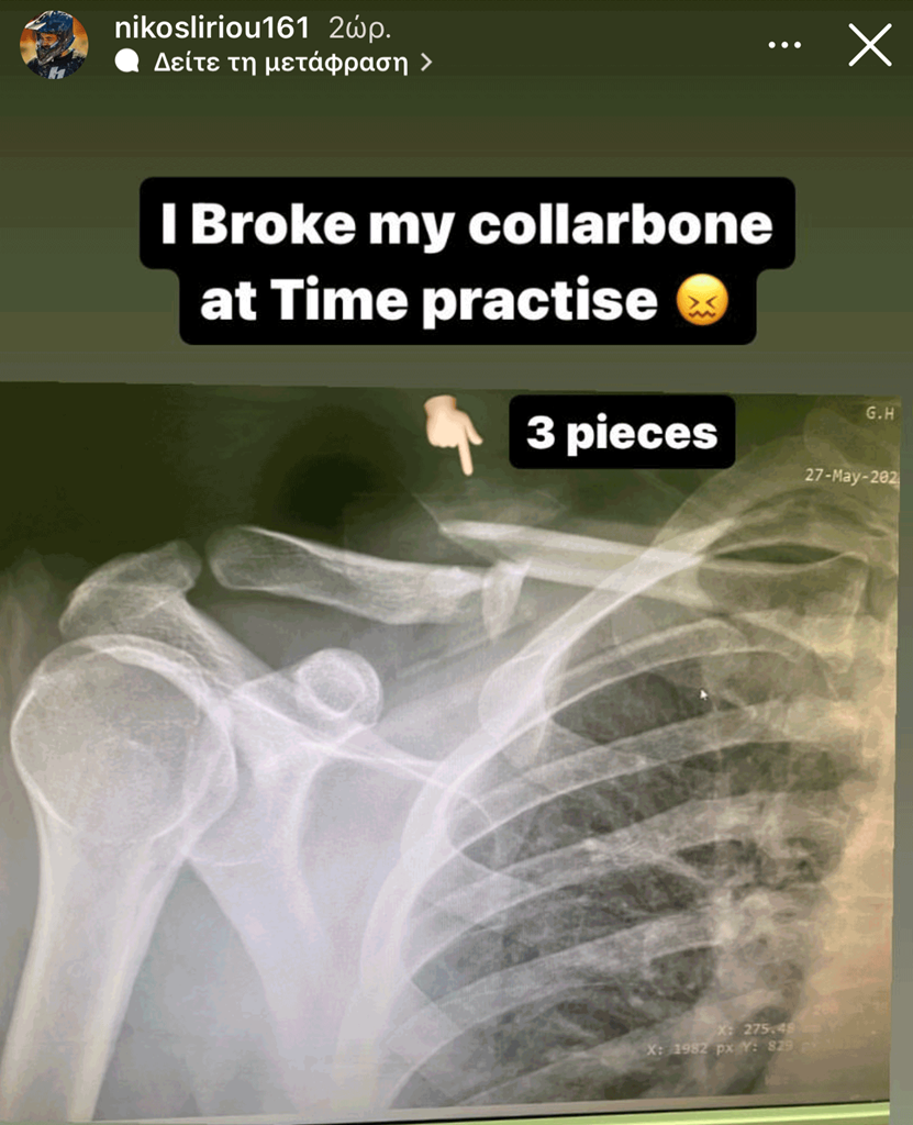 H φωτογραφία με την ακτινογραφία που ανέβασε story ο Λυρίου με σπασμένη κλείδα σε τρία μέρη...