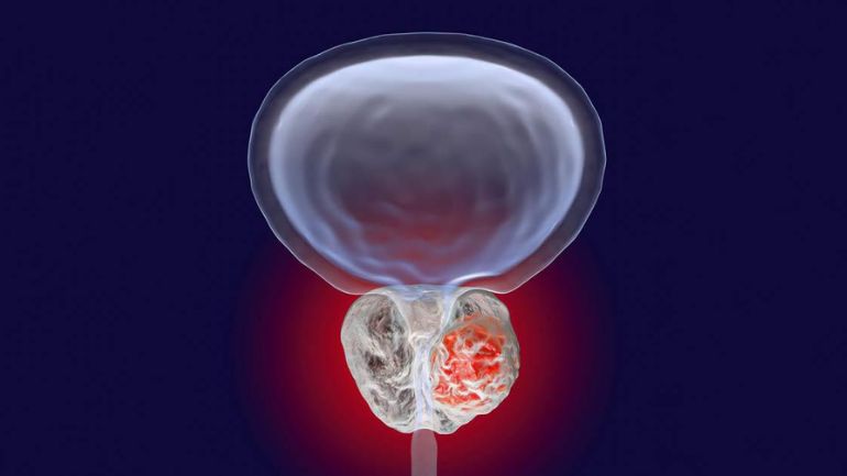 Καλοήθης Υπερπλασία Προστάτη: Σύγχρονες τεχνικές αντιμετώπισης