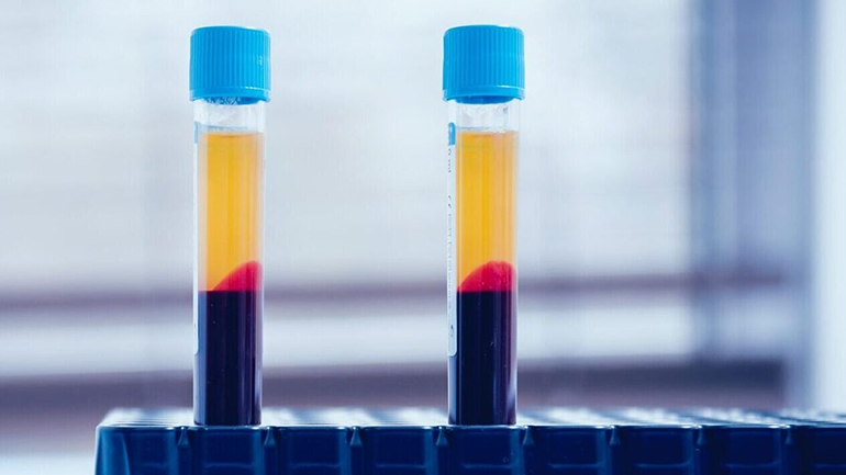 Οι ενέσεις PRP μπορεί να είναι αποτελεσματική θεραπεία για τη στυτική δυσλειτουργία