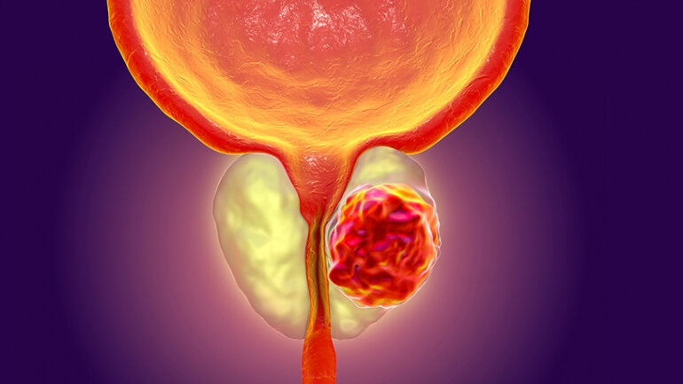 Καρκίνος του προστάτη: Τι πρέπει να ξέρετε