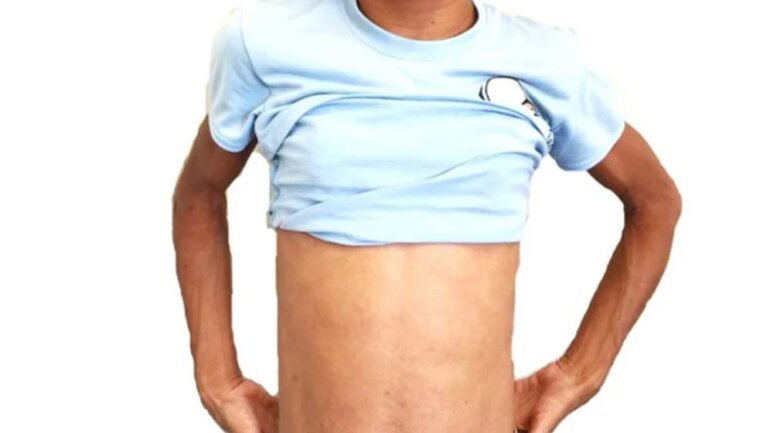 Τί είναι η λιποδυστροφία