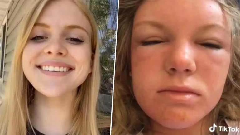 Kοιμήθηκε στην παραλία και ξύπνησε παραμορφωμένη