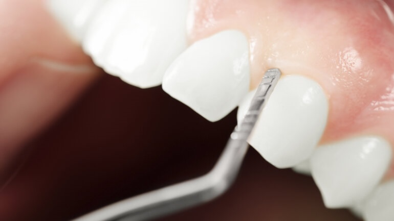 Το άτμισμα μπορεί να καταστρέψει τα καλά βακτήρια του στόματος