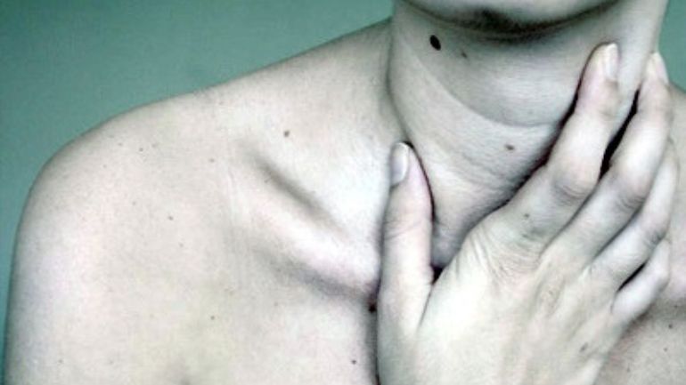 Τραγωδία στη Χαλκιδική: 16χρονη πέθανε μετά από αλλεργικό σοκ