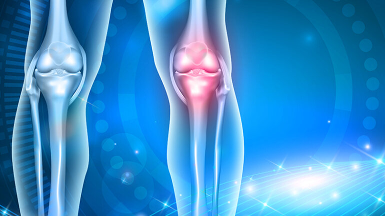 Οστεοαρθρίτιδα: Αίτια, συμπτώματα και αντιμετώπιση