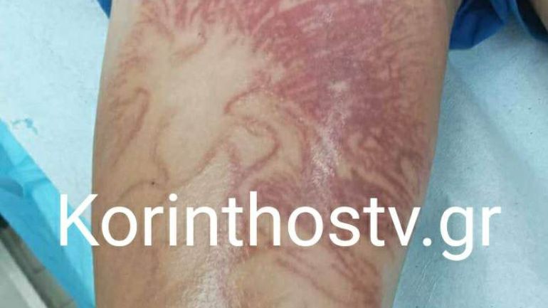 Στο νοσοκομείο 9χρονος που δέχτηκε τσίμπημα από θαλάσσια ανεμώνη στο Καλαμάκι Κορινθίας