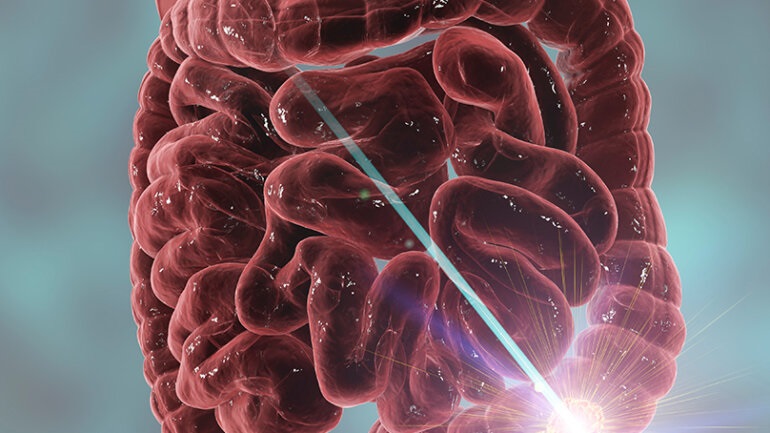 Ο κίνδυνος καρκίνου του γαστρεντερικού συστήματος σχετίζεται με την παχυσαρκία