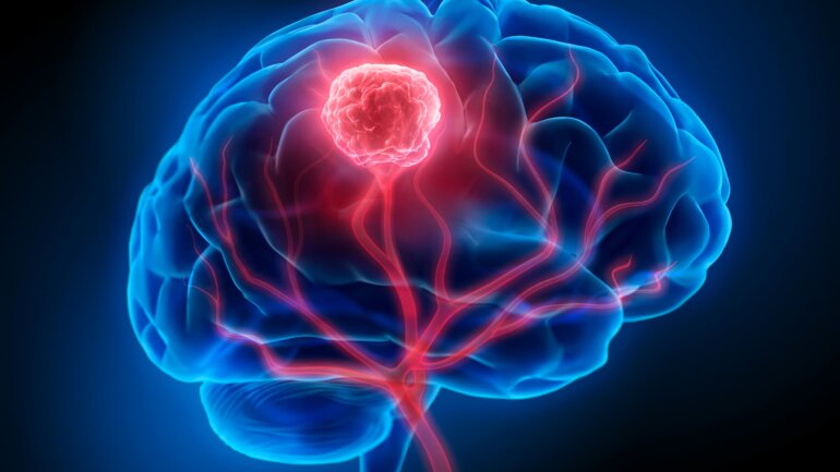 Εργαλείο τεχνητής νοημοσύνης αποκωδικοποιεί το γονιδίωμα του καρκίνου του εγκεφάλου
