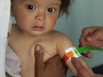 Αφγανιστάν: Ένα στα πέντε παιδιά υποφέρει από υποσιτισμό