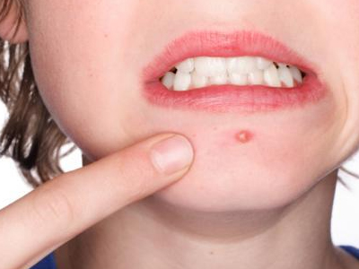 Φυσική λύση κατά της ακμής