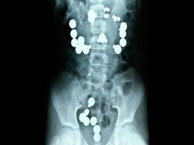 Ρωσία: Αγοράκι ενός έτους κατάπιε 42 μαγνητάκια