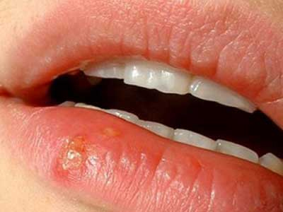 Έρπης και απώλεια μνήμης