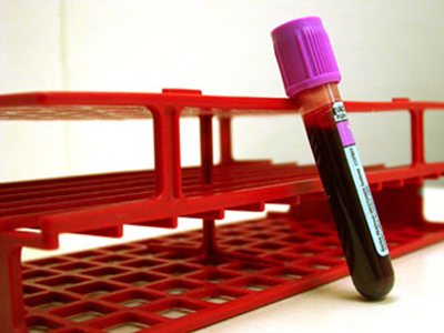 SEXUALITY: Τακτική εξέταση του ειδικού προστατικού αντιγόνου: ναι ή όχι;