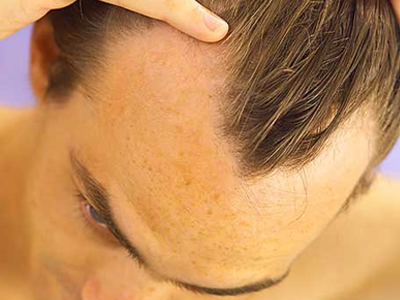 Ελπίδες για τη θεραπεία της φαλάκρας