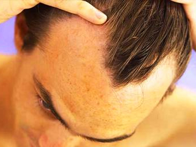 SEXUALITY:  Η χρήση φιναστερίδης μπορεί να δημιουργήσει προβλήματα;