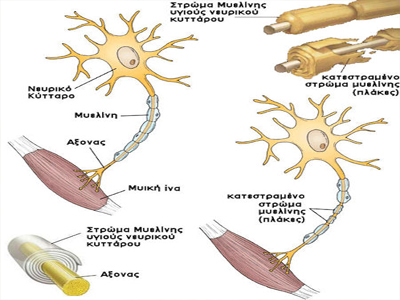Αυξήθηκε ο αριθμός των ασθενών με σκλήρυνση κατά πλάκας