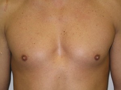 Πώς επηρεάζει η γυναικομαστία τους εφήβους;