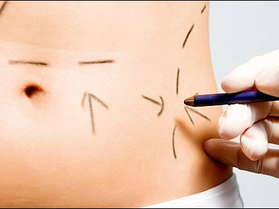 Ομογενής γιατρός κατηγορείται για θάνατο ασθενούς μετά από λιποαναρρόφηση