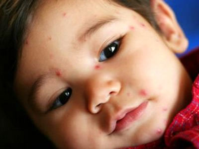 Νέο φάρμακο κατά της ιλαράς