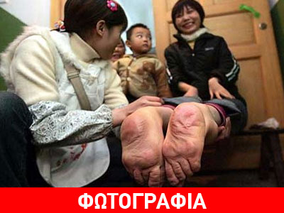 Κίνα: Γεννήθηκε με τις πατούσες της προς τα πίσω