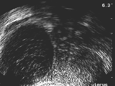 Γονιμότητα: Νέες επιστημονικές οδηγίες για την αντιμετώπιση της κύστης ωοθήκης