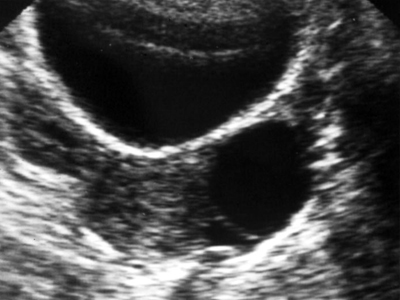 Γονιμότητα: Τι μπορεί να σημαίνει μια κύστη ωοθήκης σε μια νέα γυναίκα;