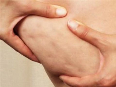 Διατροφή και κυτταρίτιδα