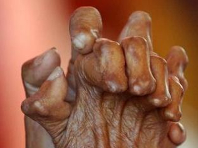 Μάστιγα η λέπρα στον Ειρηνικό