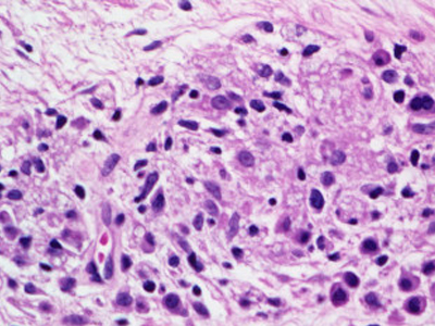 Οχάιο: Συναγερμός για λέπρα στις φυλακές