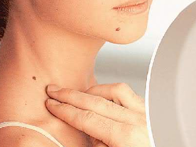 Δωρεάν εξετάσεις για μελάνωμα