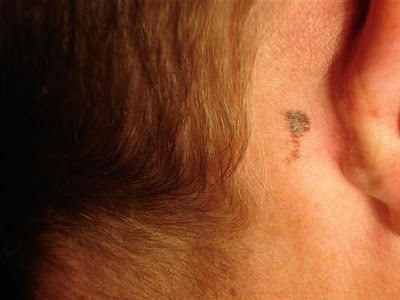 Φάρμακο για τα μελανώματα