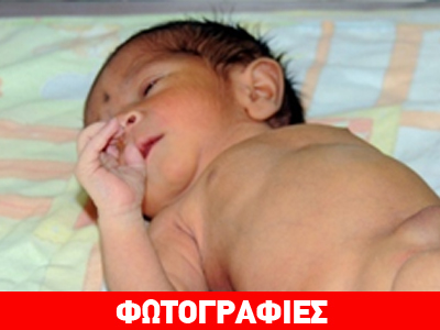 Αγώνας επιβίωσης για μωρό που γεννήθηκε με έξι πόδια!