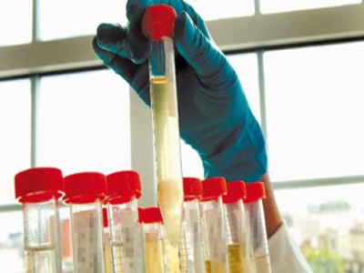 Η πρωτεΐνη στα ούρα σχετίζεται με το προσδόκιμο ζωής