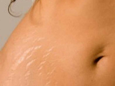 Κρέμα για τις ραγάδες με απλά υλικά