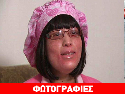 Σοκ: «Φυτρώνουν» νύχια σε όλο της το σώμα