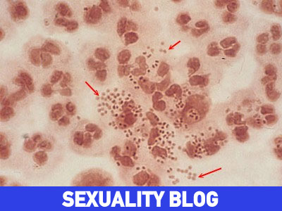 Έχω κάνει θεραπεία για σύφιλη, αλλά είμαι πάλι θετικός, Τι να κάνω;