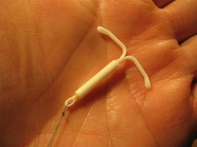 Γονιμότητα: Το ενδομητρικό σπιράλ προστατεύει από τον καρκίνο του τραχήλου της μήτρας