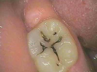 Η τερηδόνα είναι μεταδοτική Η τερηδόνα είναι μεταδοτική