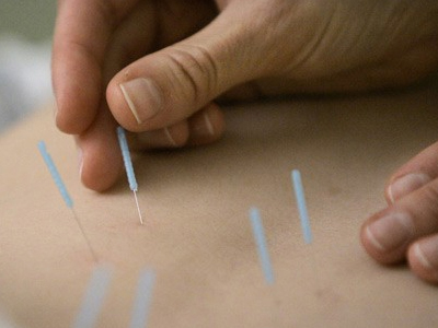 Γονιμότητα: Ο βελονισμός δεν είναι χρήσιμος σε γυναίκες με ΣΠΩ