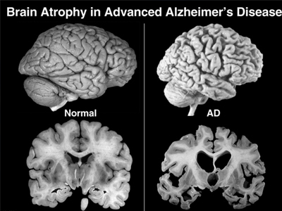 Διάγνωση του Αλτσχάιμερ δέκα χρόνια πριν εκδηλωθεί