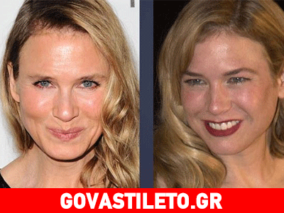 Η Ρενέ Ζελβέγκερ έκανε βλεφαροπλαστική για να δείχνει βορειοευρωπαία!