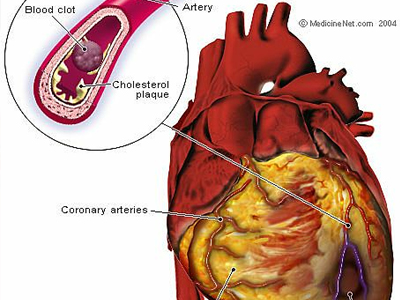 Πρωτοποριακή θεραπεία για καρδιακή ανεπάρκεια;