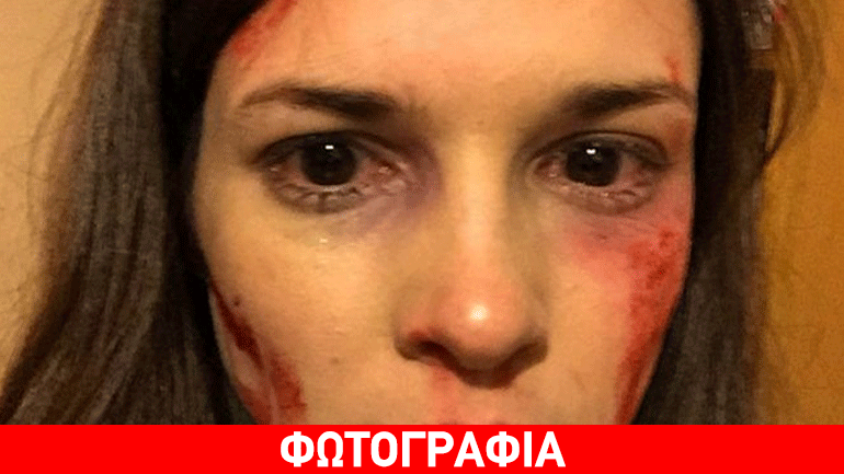 Με αίματα και μώλωπες στο πρόσωπο η Ευγενία Δημητροπούλου