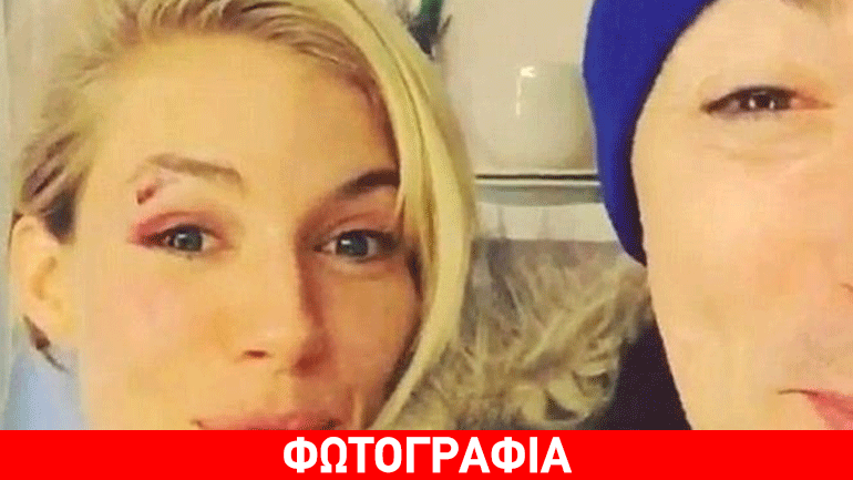 Ατύχημα και ράμματα για τη Sienna Miller! Τι συνέβη;